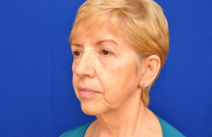 Facelift Before & After Pictures Green, OH