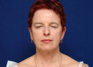 Facelift Before & After Pictures Green, OH