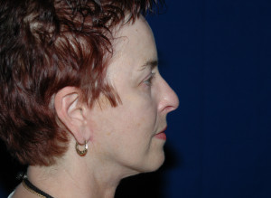 Facelift Before & After Pictures Green, OH