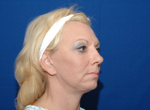 Facelift Before & After Pictures Green, OH