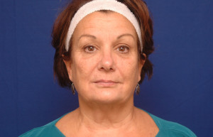 Facelift Before & After Pictures Green, OH