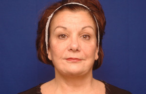 Facelift Before & After Pictures Green, OH