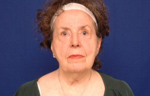 Facelift Before & After Pictures Green, OH