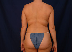 Liposuction Before & After Pictures Green, OH