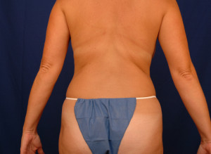 Liposuction Before & After Pictures Green, OH