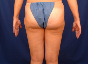 Liposuction Before & After Pictures Green, OH