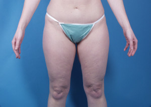 Liposuction Before & After Pictures Green, OH