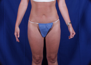 Liposuction Before & After Pictures Green, OH