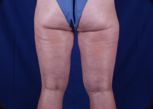 Liposuction Before & After Pictures Green, OH