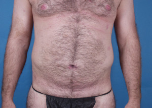 Liposuction Before & After Pictures Green, OH