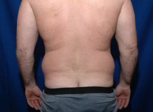 Liposuction Before & After Pictures Green, OH