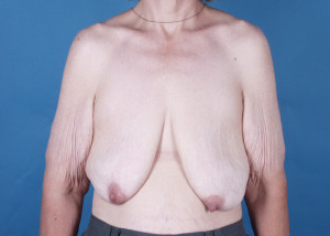 Breast Reconstruction Before & After Pictures Green, OH