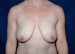 Breast Reconstruction Before & After Pictures Green, OH