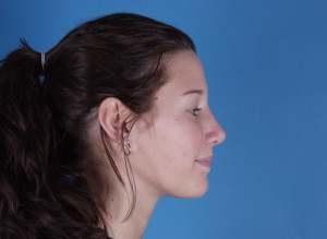 Rhinoplasty Before & After Pictures Green, OH