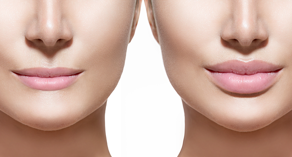 The Difference Between Injectables and Fillers