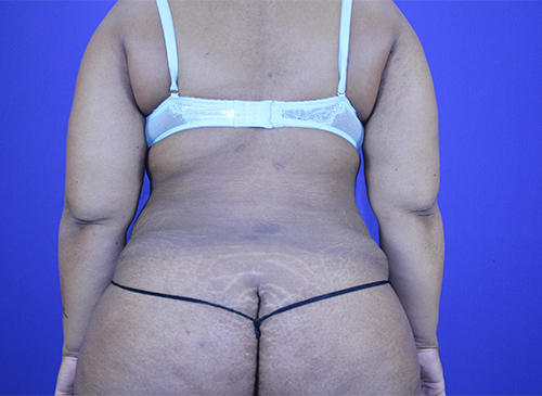 Liposuction Before and After Pictures Akron, OH