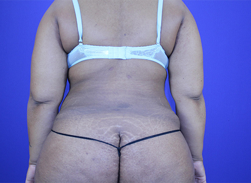 Liposuction Before & After Pictures Green, OH