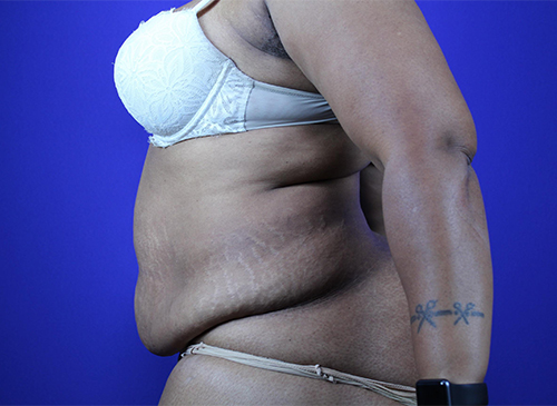 Liposuction Before and After Pictures Akron, OH