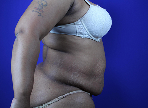 Liposuction Before and After Pictures Akron, OH