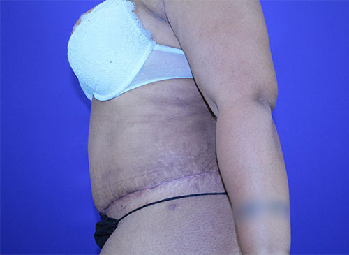 Tummy Tuck Before & After Pictures Green, OH