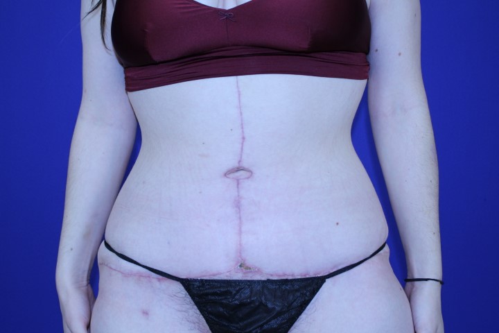 Tummy Tuck Before & After Pictures Green, OH