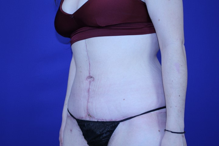 Tummy Tuck Before & After Pictures Green, OH