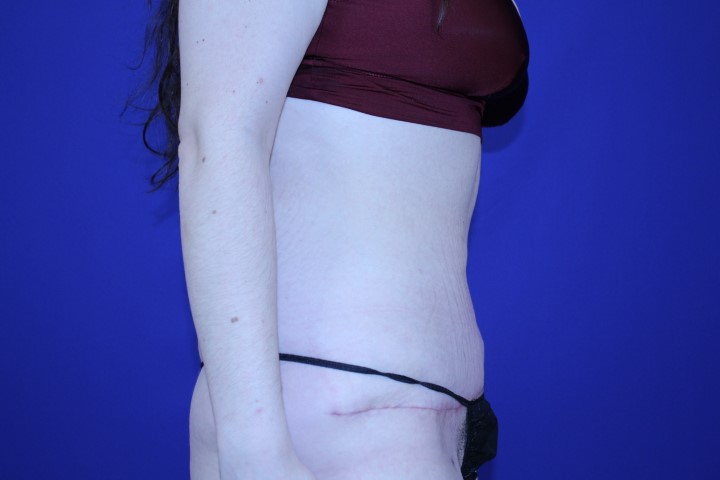 Tummy Tuck Before & After Pictures Green, OH