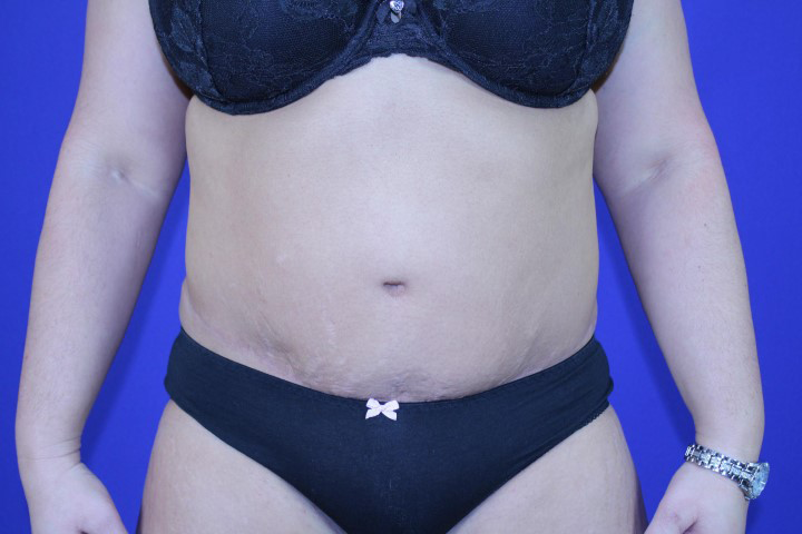 Tummy Tuck Before & After Pictures Green, OH