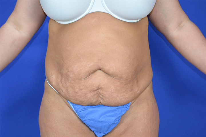 Tummy Tuck Before and After Pictures Akron, OH