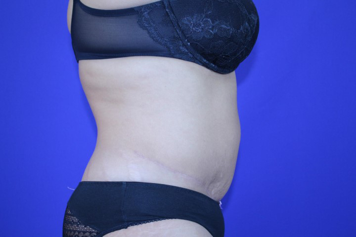 Tummy Tuck Before and After Pictures Akron, OH