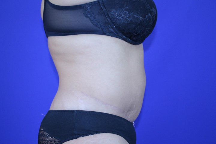 Tummy Tuck Before & After Pictures Green, OH