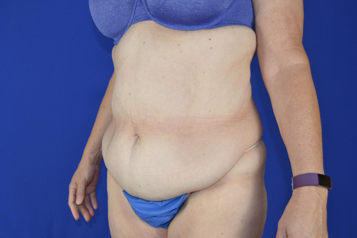 Tummy Tuck Before & After Pictures Green, OH