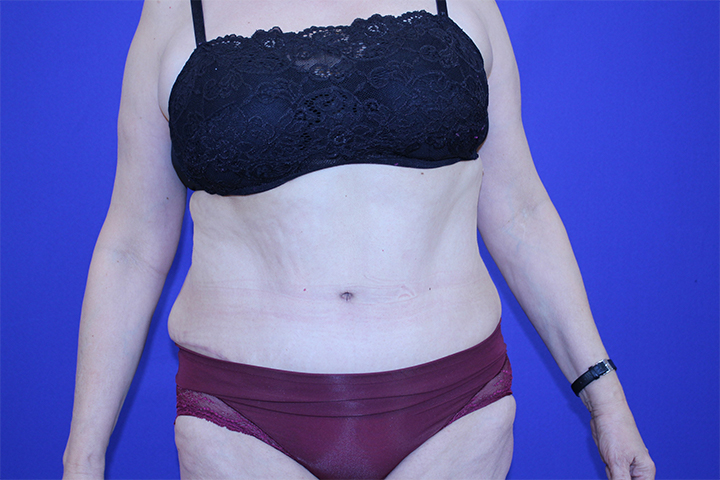 Tummy Tuck Before and After Pictures Gallery Green, OH