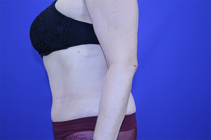 Tummy Tuck Before & After Pictures Green, OH
