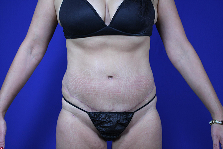 Tummy Tuck Before & After Pictures Green, OH