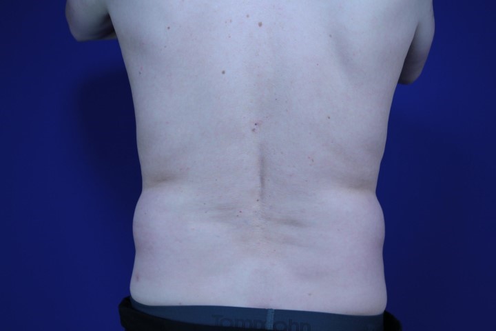 CoolSculpting Before & After Pictures Green, OH
