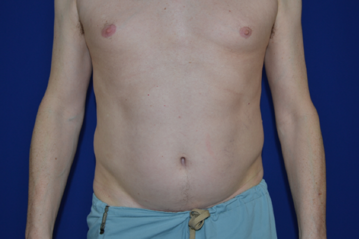 CoolSculpting Before & After Pictures Green, OH