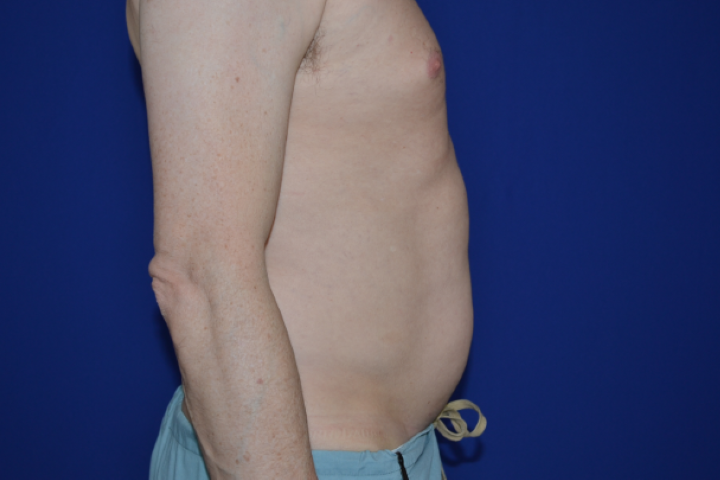 CoolSculpting Before & After Pictures Green, OH