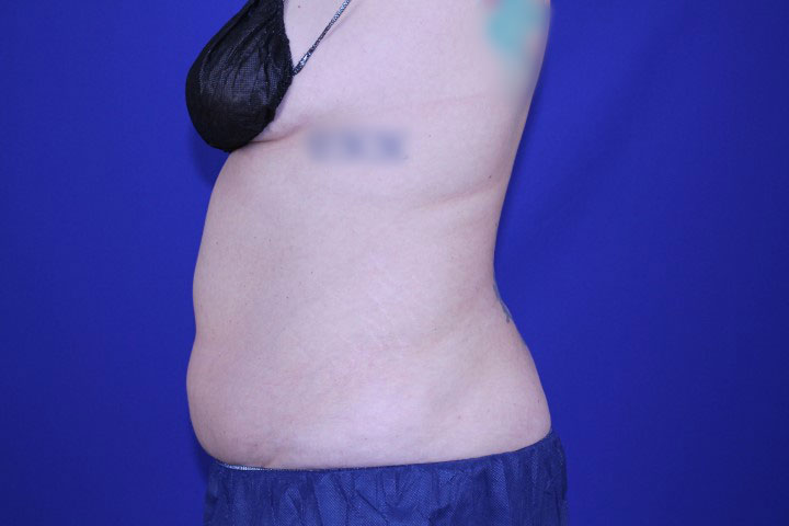 CoolSculpting Before & After Pictures Green, OH