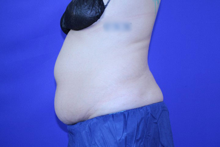 CoolSculpting Before & After Pictures Green, OH