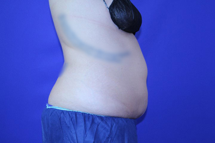 CoolSculpting Before & After Pictures Green, OH