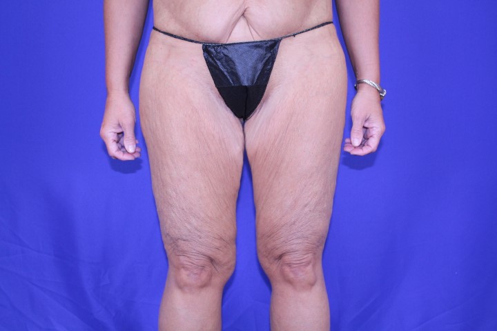 Thighplasty Before & After Pictures Green, OH