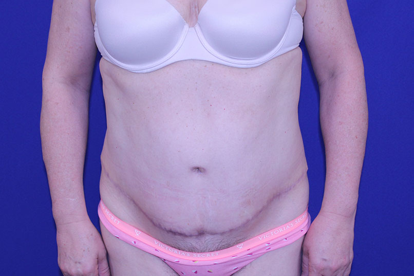 Tummy Tuck Before & After Pictures Green, OH