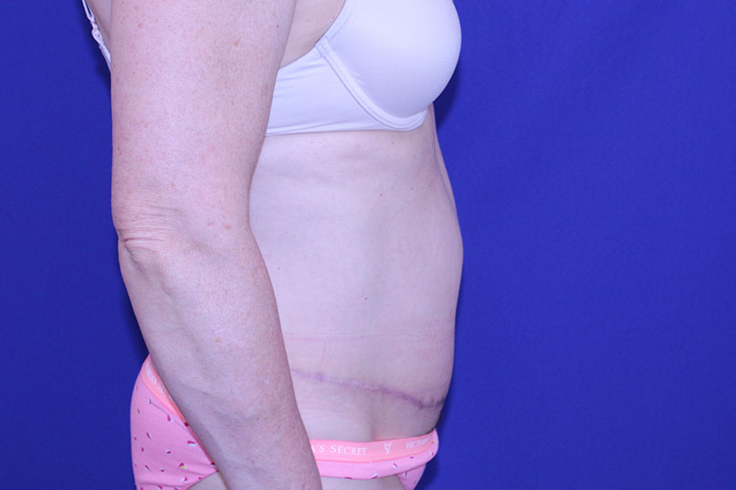 Tummy Tuck Before & After Pictures Green, OH