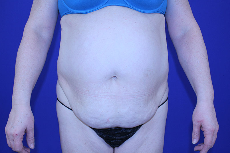 Tummy Tuck Before & After Pictures Green, OH