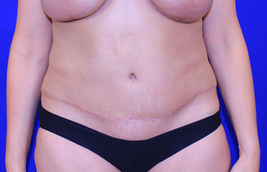 Tummy Tuck Before and After Pictures in Akron, OH