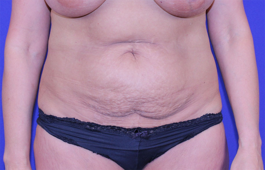 Tummy Tuck Before and After Pictures Gallery Green, OH