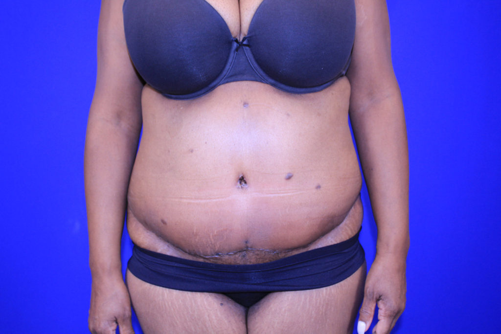 Tummy Tuck Before and After Pictures in Green, OH