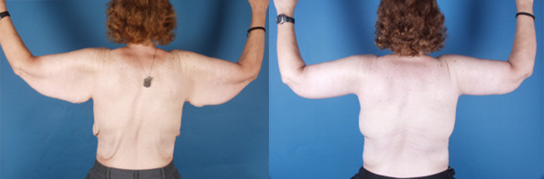 arm1 Arm Lift in Akron, OH
