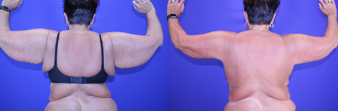 arm2 Arm Lift in Akron, OH